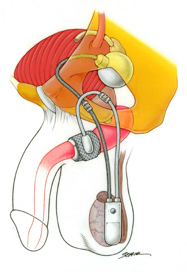 Искусственный мочевой сфинктер. Искусственный сфинктер мочевого пузыря AMS-800. Сфинктер мочевого пузыря у мужчин. AMS 800 искусственный сфинктер операция. Имплантация искусственного сфинктера мочевого пузыря.